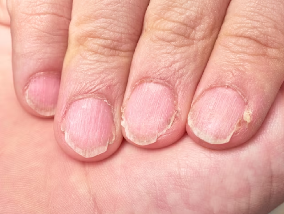 علاج أمراض الأظافر